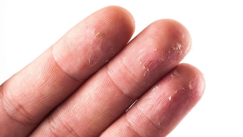 Tróc da tay chân – cảnh báo thiếu Vitamin C và Kẽm từ bên trong cơ thể
